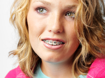 Close up of  woman's face and mouth with braces