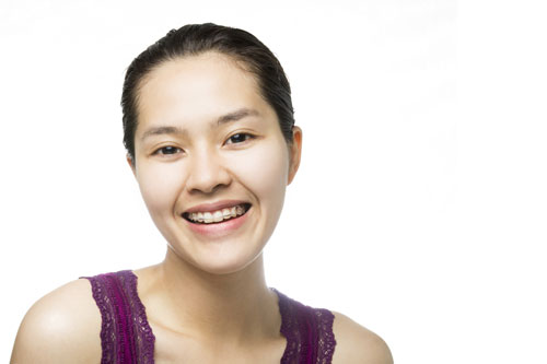 smiling patient showing orthodontics for correcting malocclusion