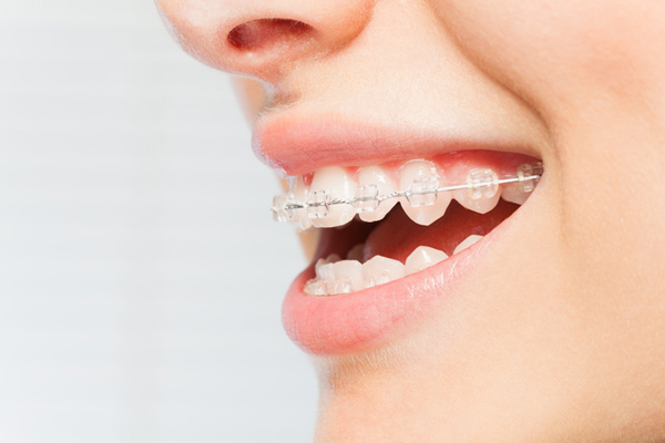 Side view of woman's smile with ceramic braces on her teeth at Raleigh Family Orthodontics in Raleigh, NC