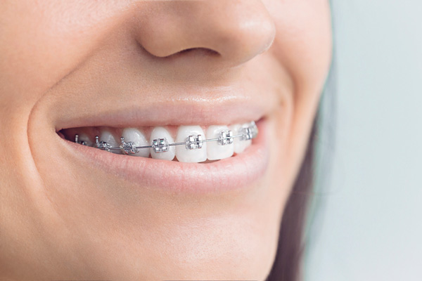 Close up of patient smiling after getting braces at Raleigh Family Orthodontics in Raleigh, NC