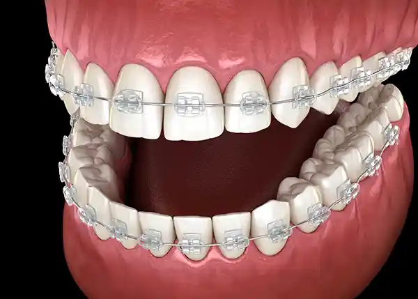 Close up of teeth with clear braces, an orthodontic treatment option that is aesthetic and visually minimal.