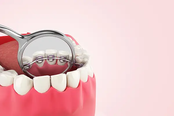 A dental mirror showing lingual braces placed on the back side of the teeth for discreet orthodontic treatment.