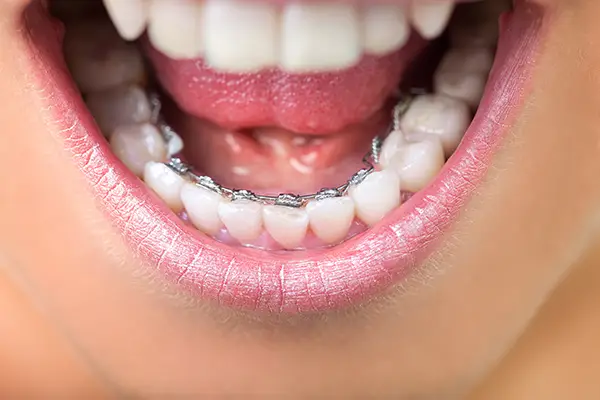 A close-up of a patient smiling, showing lingual braces attached to the back side of the lower teeth for discreet alignment.