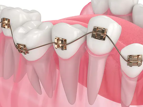 Braces attached to teeth with a metal wire, demonstrating orthodontic mechanisms and teeth alignment.